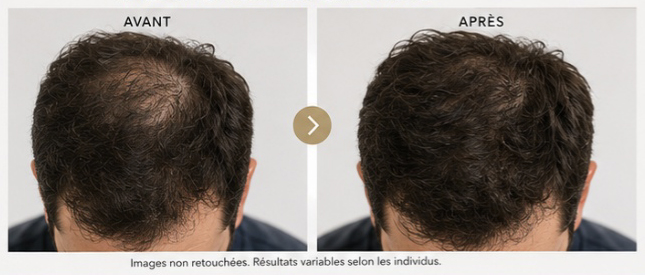 Avant Après Microneedling cheveux